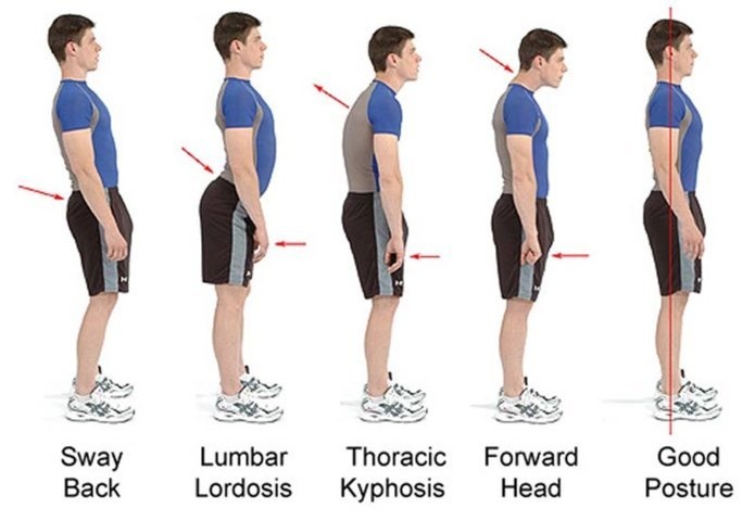 A helytelen testtartás típusai és korrekciója